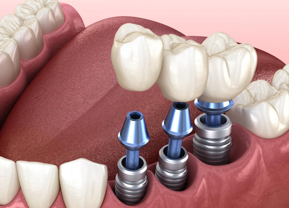 Dental Implant Turkey