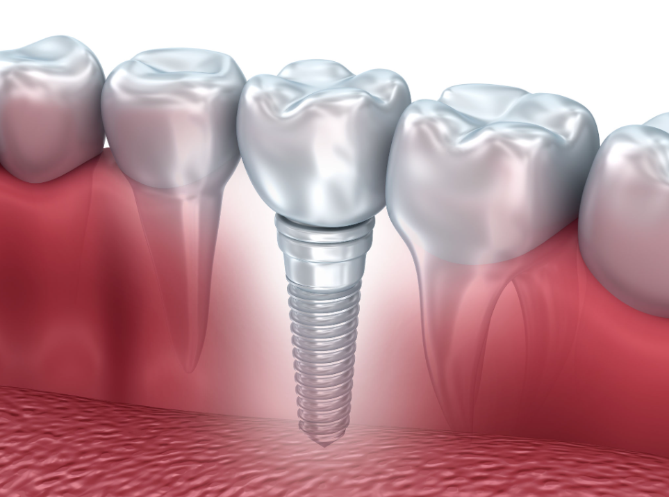 Dental Implant Turkey